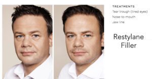 Restylane Man Before And After Patient Bennett C Yang MD