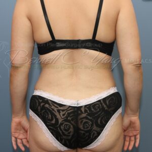How to get rid of back fat and bra roll - Squlptbody