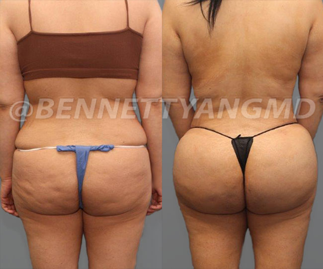 BBL Before And After Pictures, Brazilian Butt Lift Images Washington DC