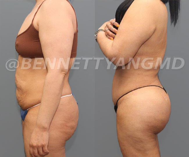 Before and After Awake Tickle of mid Back/ bra-line fat and love handles.  Next day!!! She is thrilled!!!