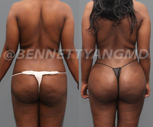 Reflections Center for Cosmetic Medicine - Hip dips or violin hips  correction has become a common request in our office. While Brazilian Butt  Lift (BBL) is about lifting the butt using fat