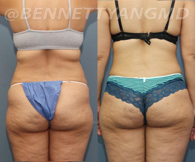 Before and After Awake Tickle of mid Back/ bra-line fat and love handles.  Next day!!! She is thrilled!!!