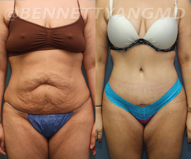 Tummy Tuck 360 Before and After Photo Gallery