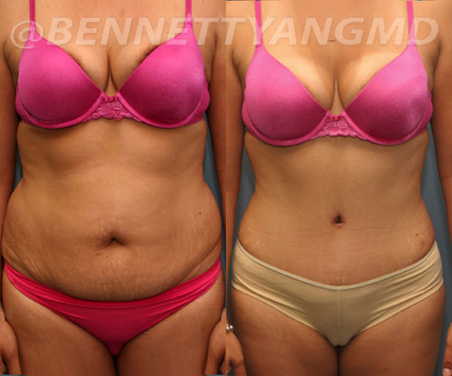 VASER Liposuction LIPO360 Before And After Pictures