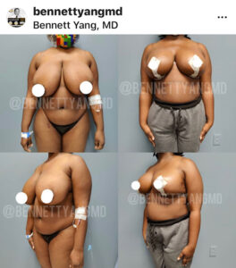 Medical Insurance Breast Reduction Surgeon Maryland