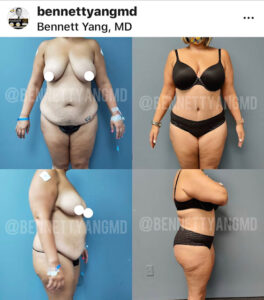 Plastic Surgery Financing $203 /mo Tummy Tuck Payment Plan