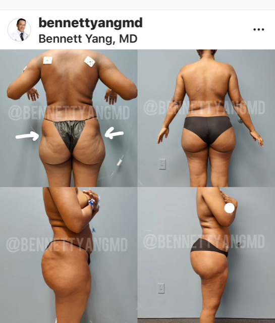 Buttock augmentation, sometimes referred to as a BBL or Brazilian