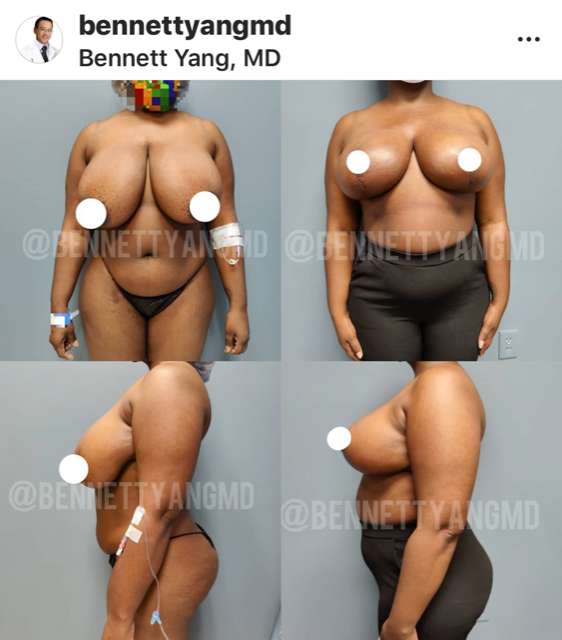 Artist and r posts pictures of her breast reduction on