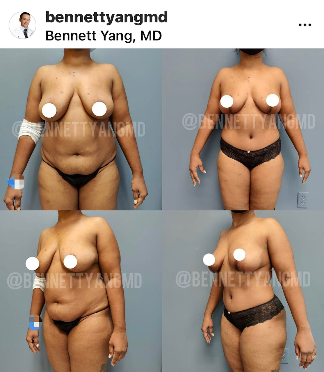 DMV - BBL - LIPO360 - Snatched Waist - View Hundreds Of Before And After  Images
