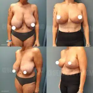 Expert Breast Lift Surgery Maryland - Correction