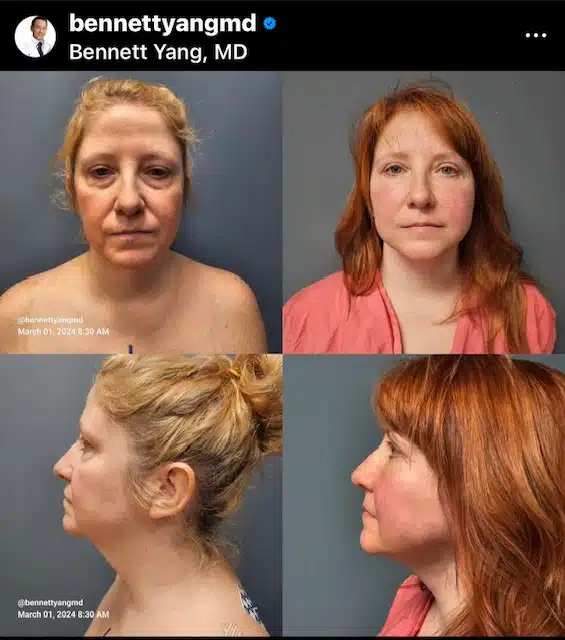 Photo Gallery Maryland Face Surgeon Facelift Before and After