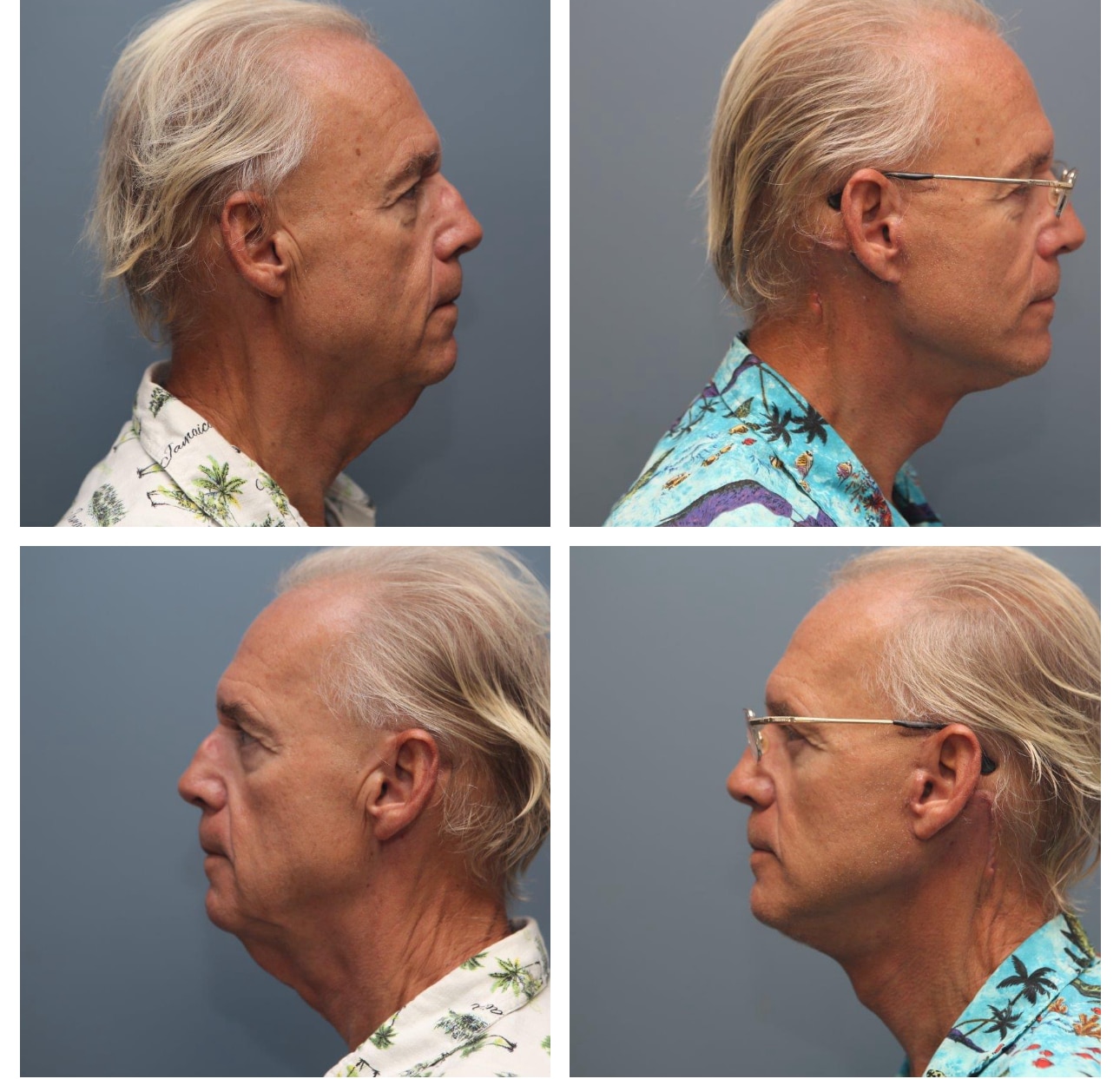 Male Neck Lift Before and After Images - Bennett Yang MD