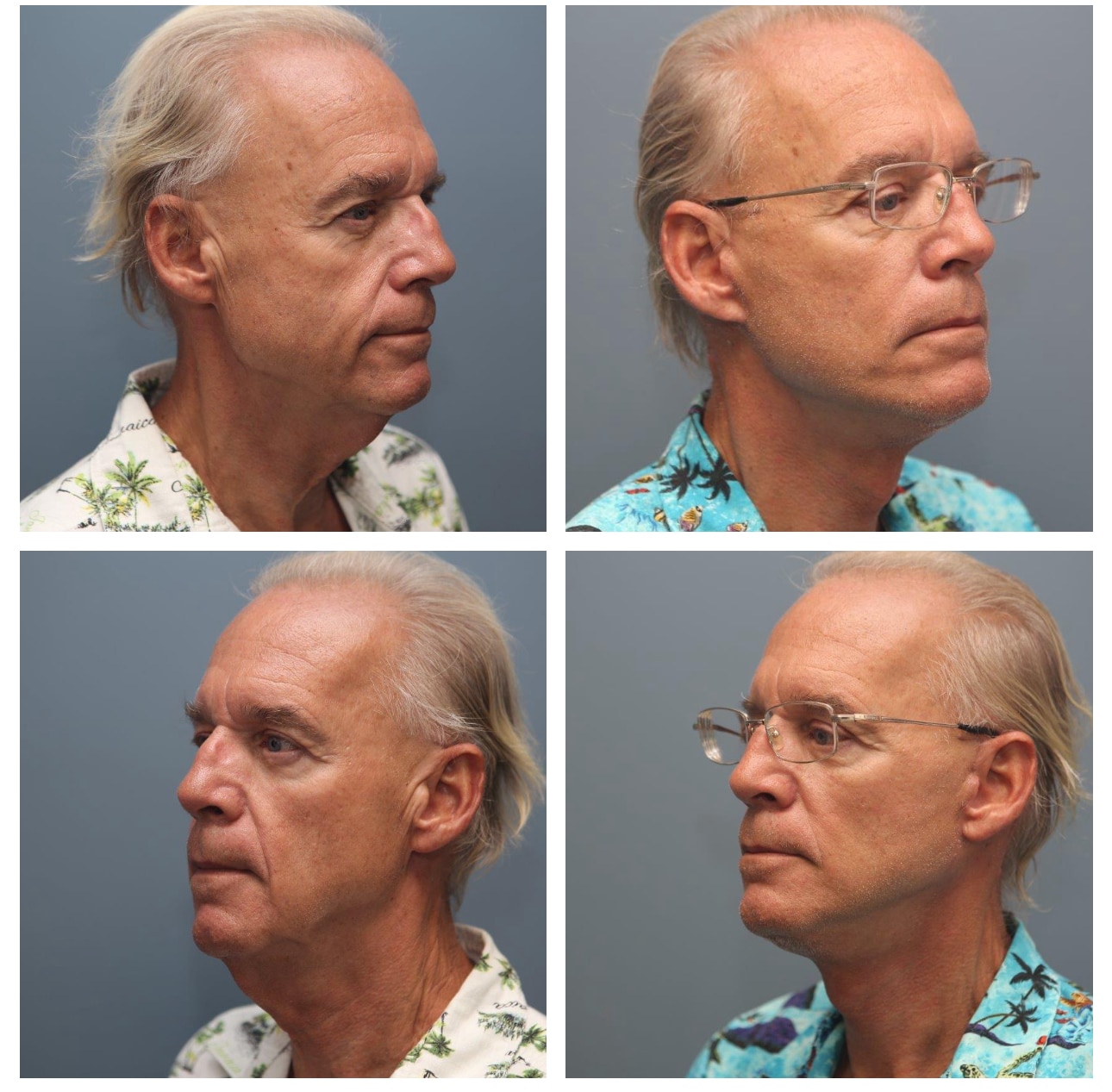 Male Neck Lift Before and After Images - Bennett Yang MD