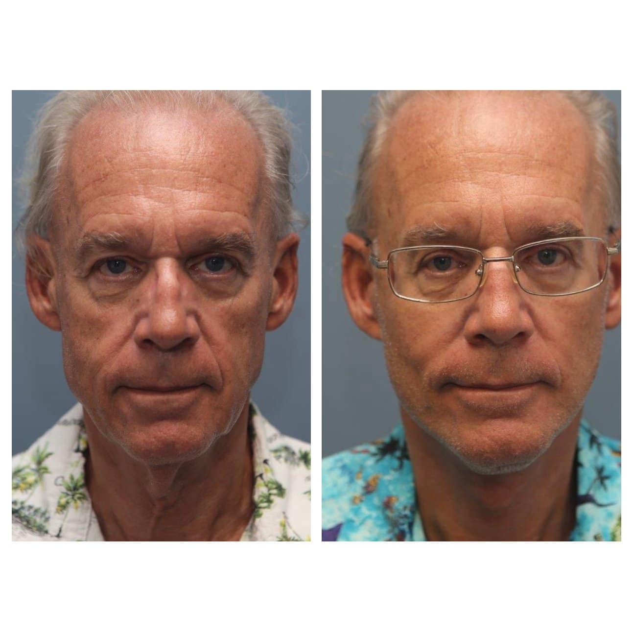 Male Neck Lift Before and After Images - Bennett Yang MD