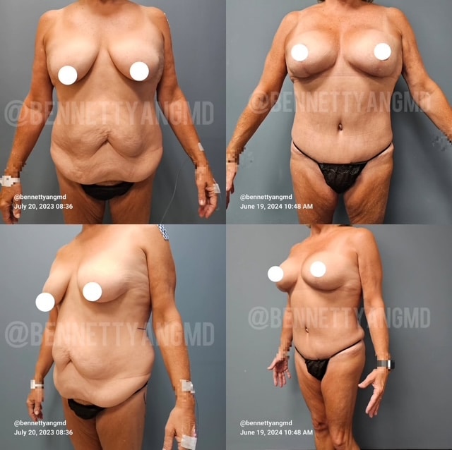 After Weight Loss Breast Augmentation with Lift