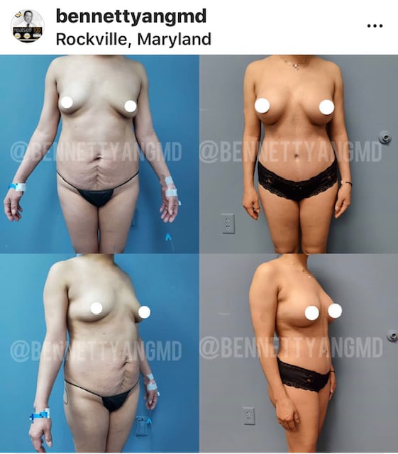 Subfascial Breast Implants Before After