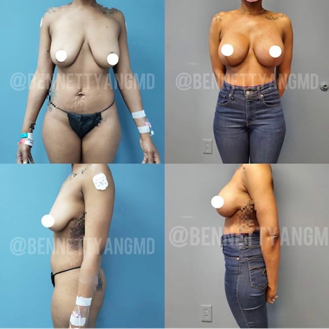 Breast Augmentation with A Breast Lift Before and After Images