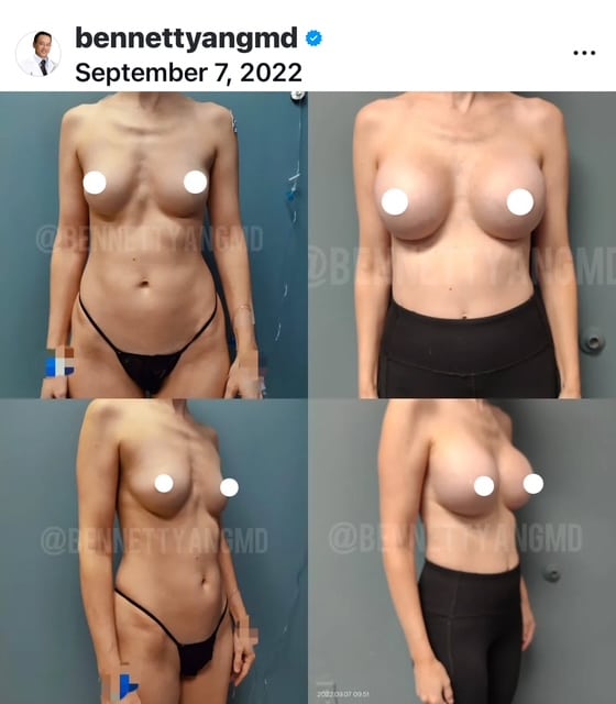 Subfascial Breast Implants Before After