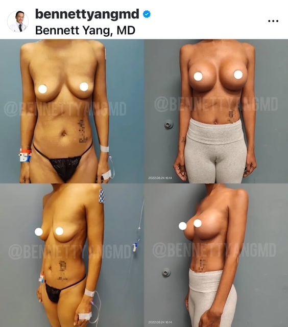 Subfascial Breast Implants Before After