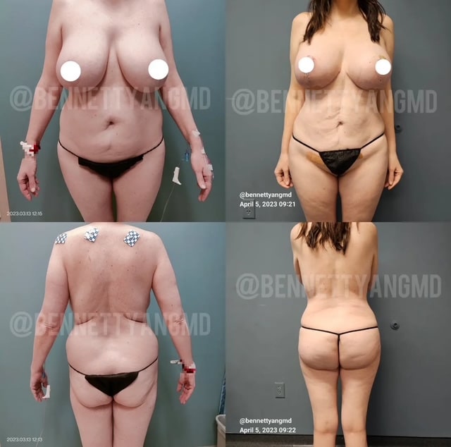 breast augmentation after rapid weight loss