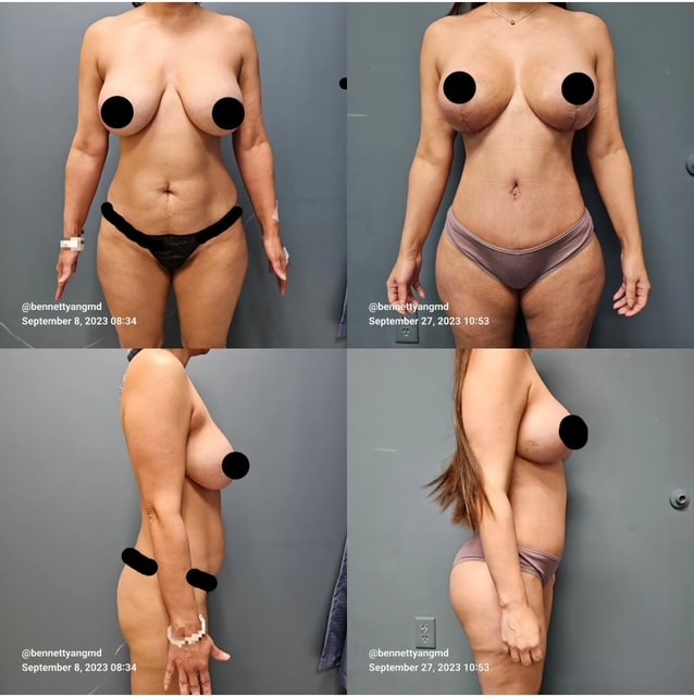 breast augmentation after rapid weight loss