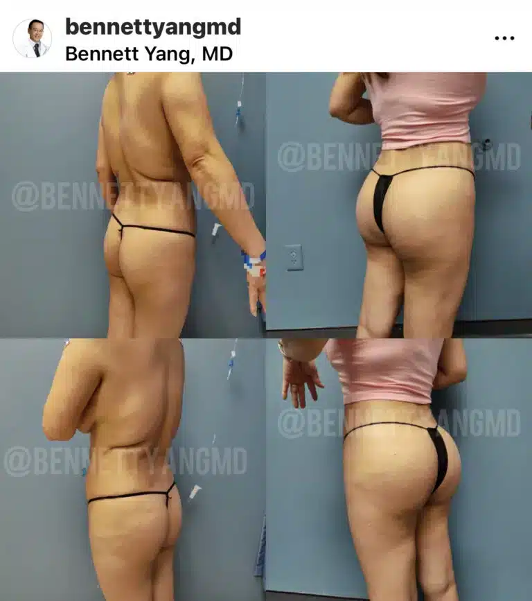 LIPO 360 before and after images