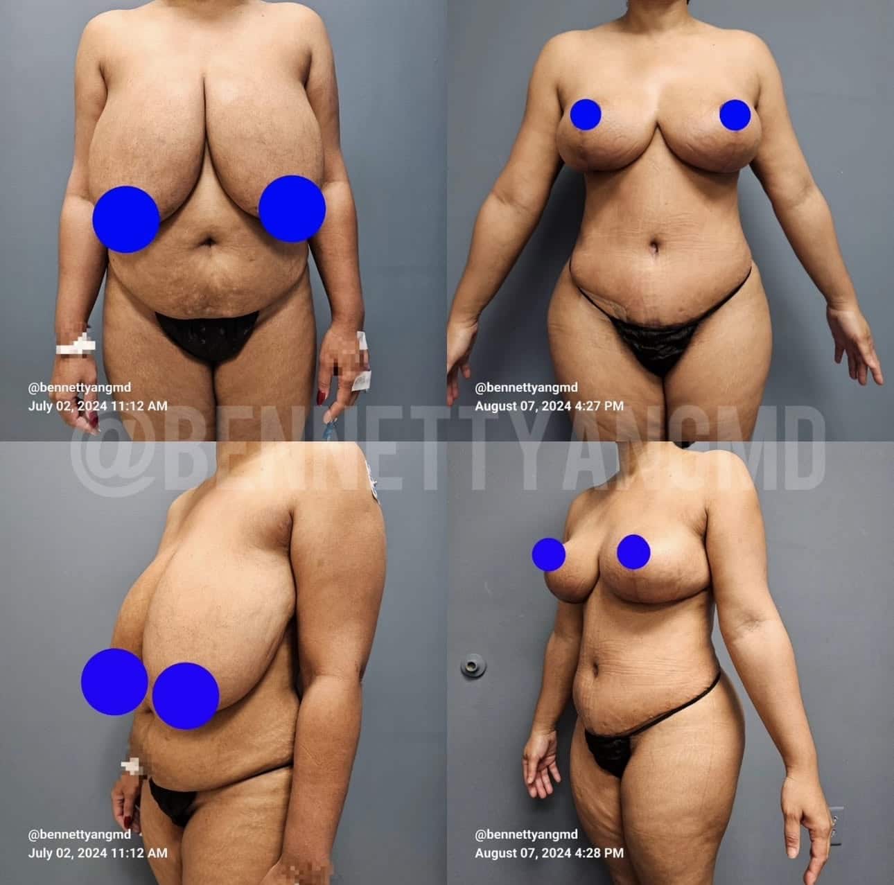 Mommy Makeover - Tummy Tuck
