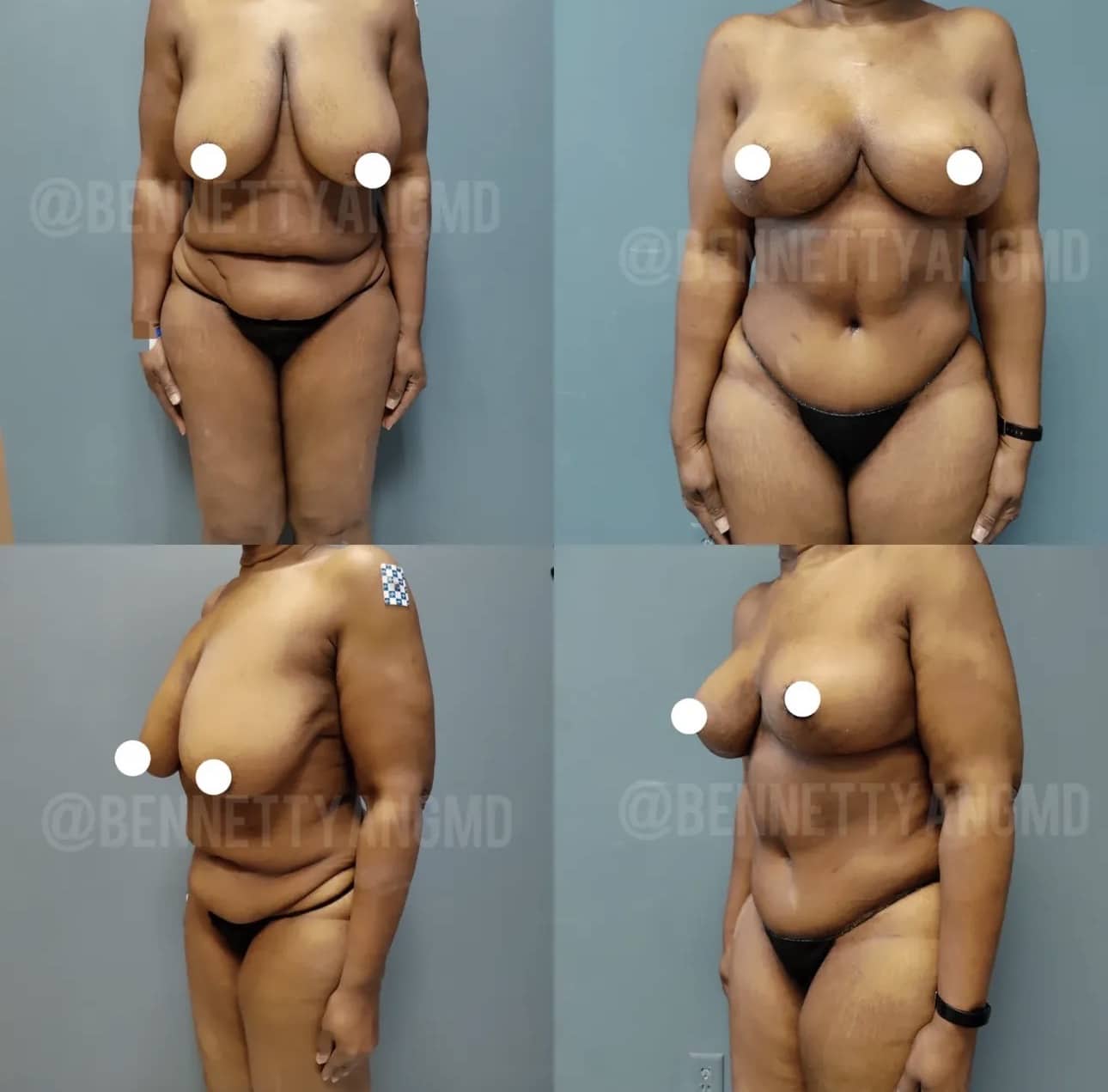 Mommy Makeover - Tummy Tuck Before and after images