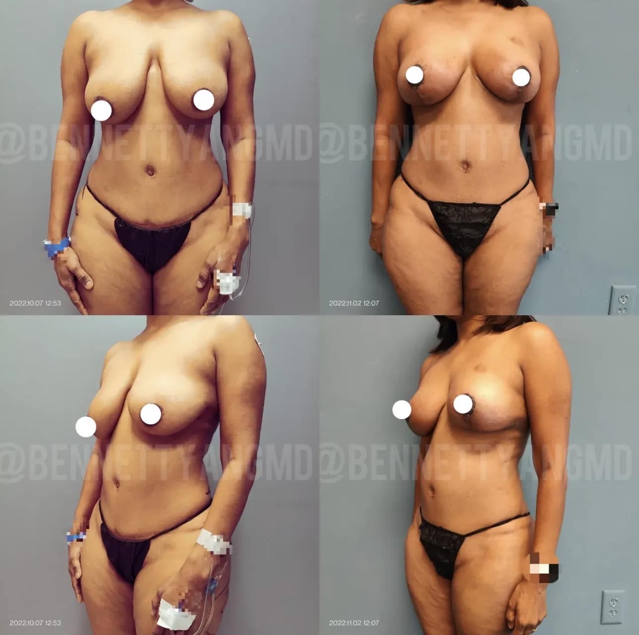 Mommy Makeover - Tummy Tuck Before and after images