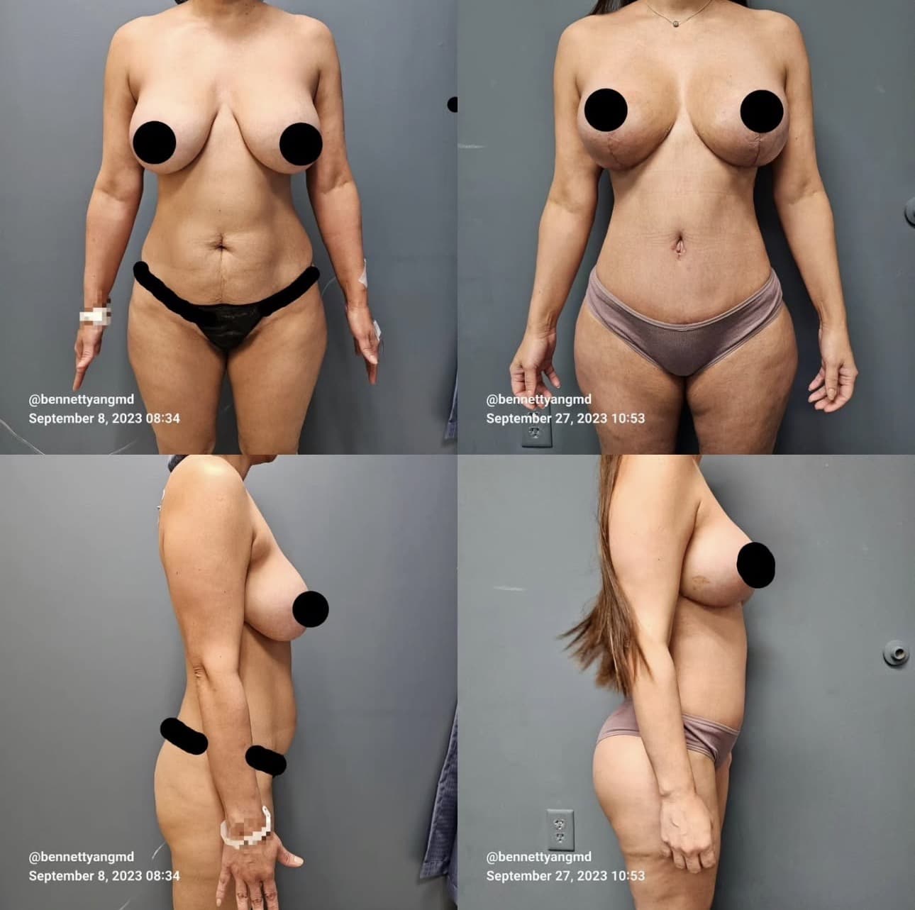 Mommy Makeover - Tummy Tuck Before and after images