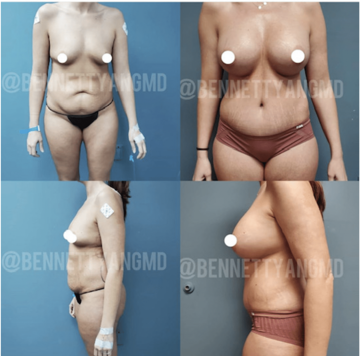 Breast Lift Rockvile Maryland