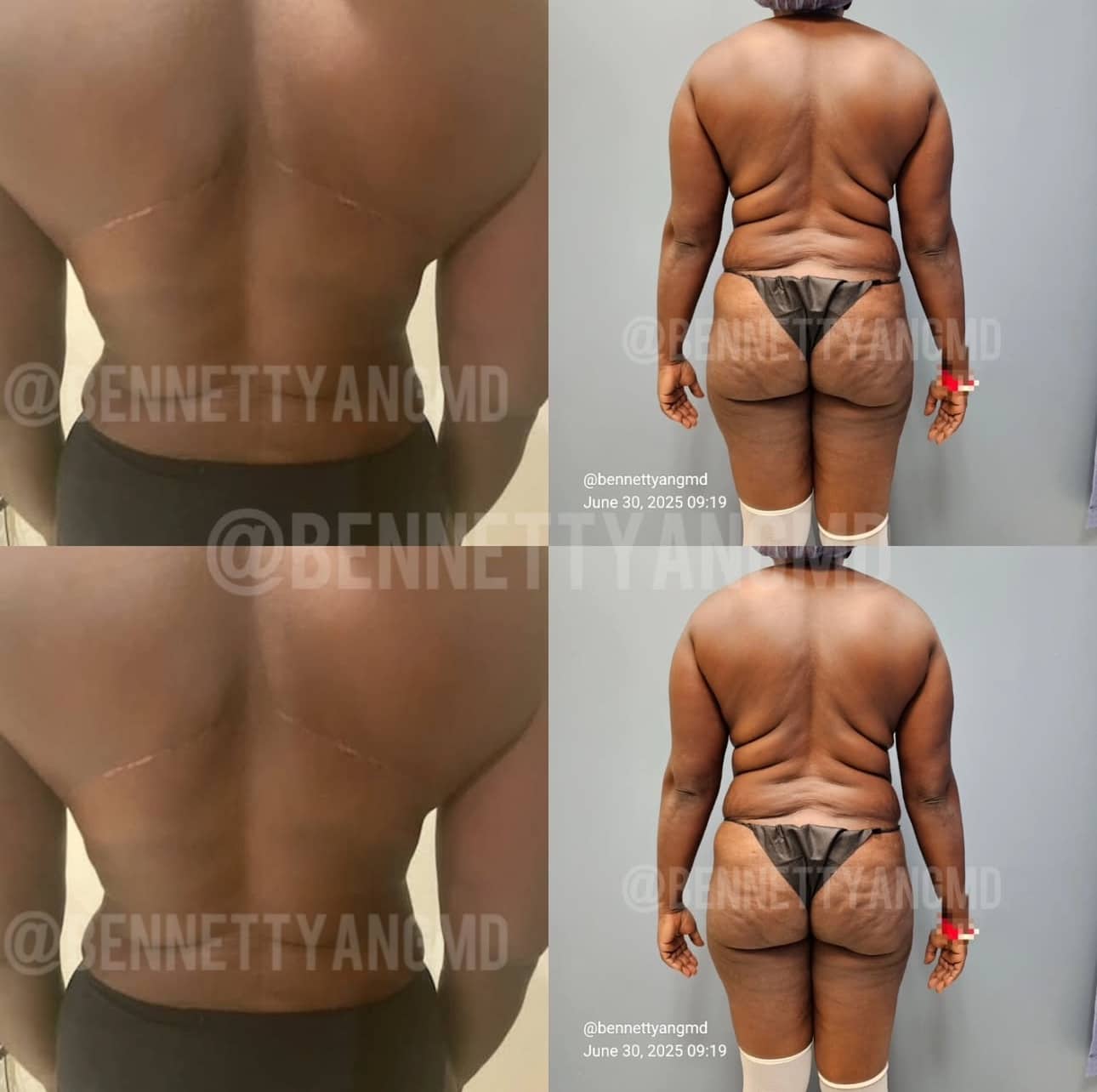 Back Lift - Back Roll Removal After Weight loss