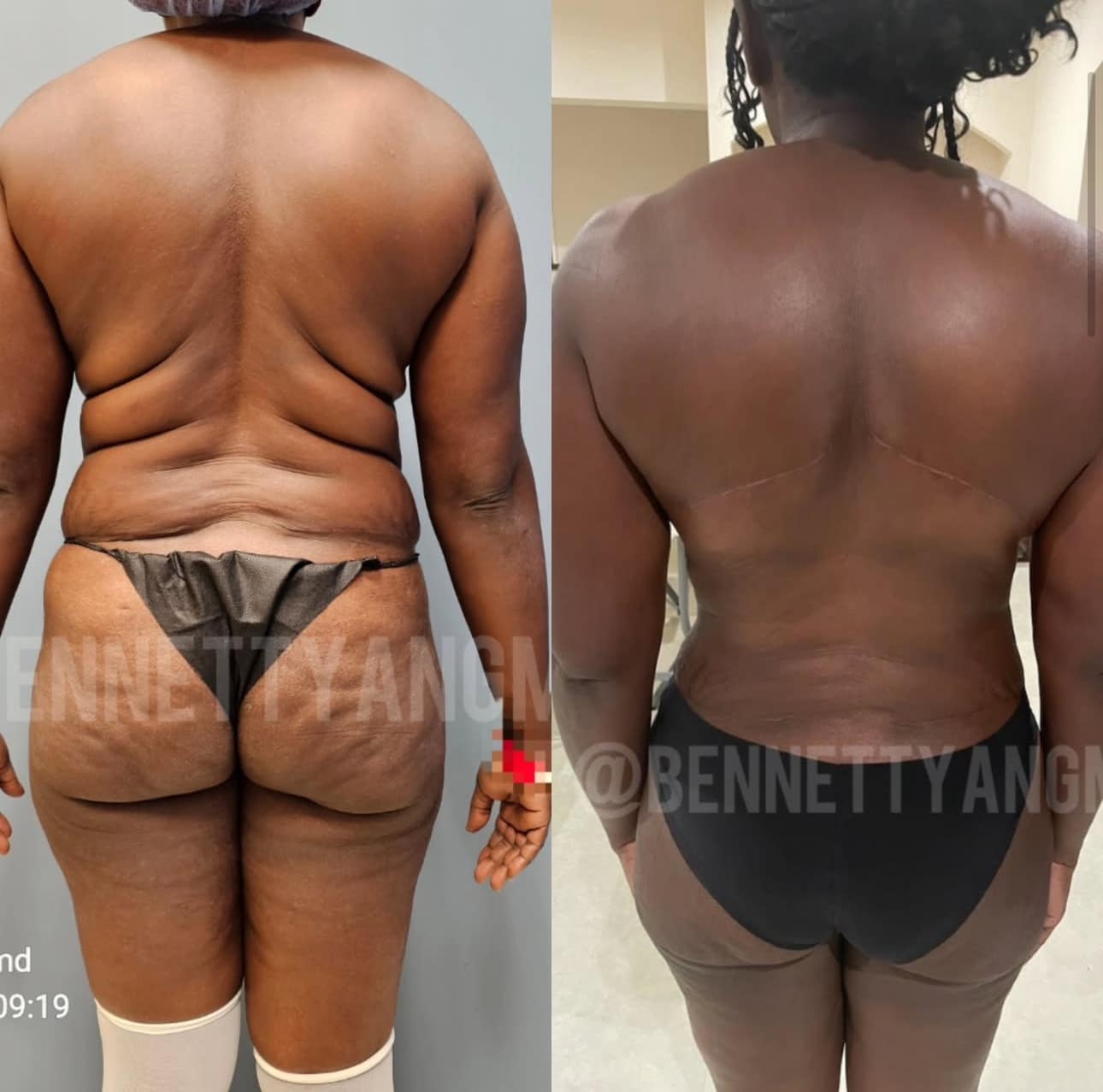 Back Lift Bra Roll Removal After Weight loss